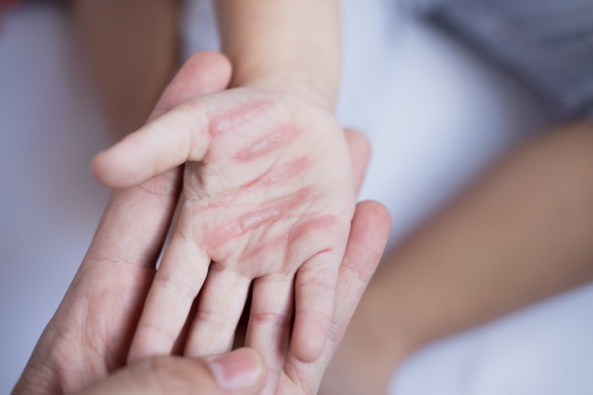 Neue klinische Studie bestätigt: BIOPTRON® beschleunigt die Wundheilung von Verbrennungen